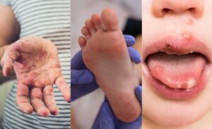 Read more about the article Homeopathic Remedies for Hand, Foot and Mouth Disease