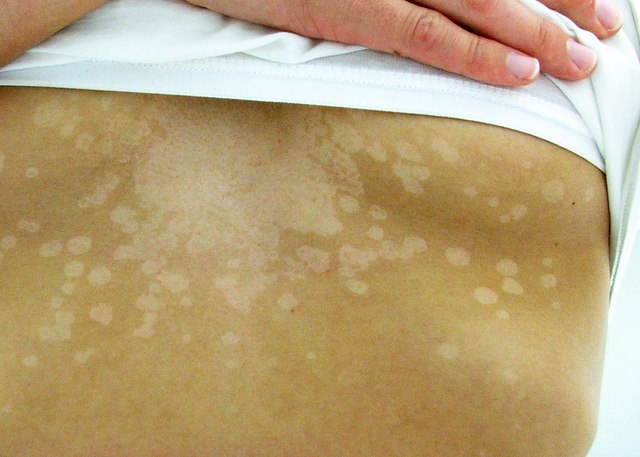 Homeopathic-treatment-for-tinea-versicolor