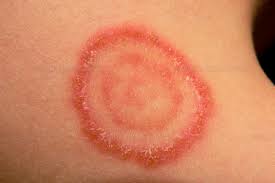Homeopathic-treatment-for-dermatophytosis
