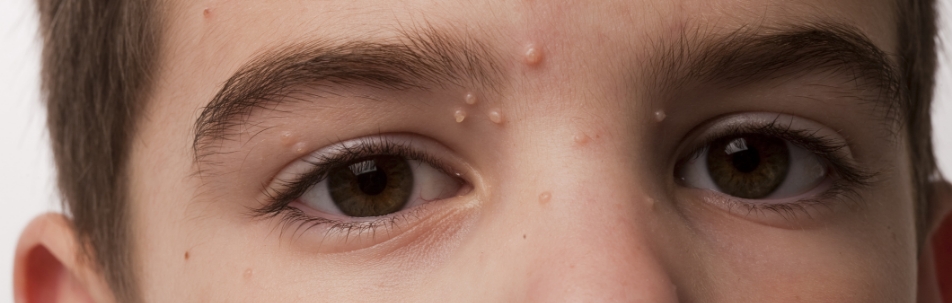 Homeopathic treatment for molluscum contagiosum