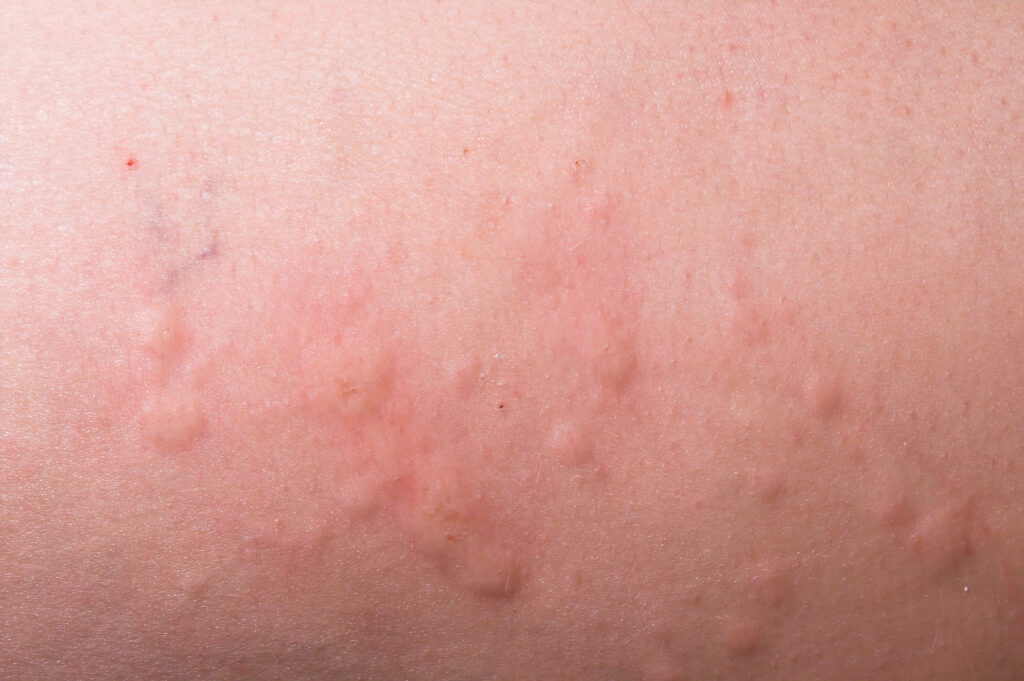 Homeopathic-treatment-for-skin-allergies