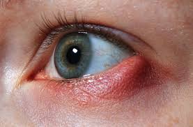 Homeopathy for styes