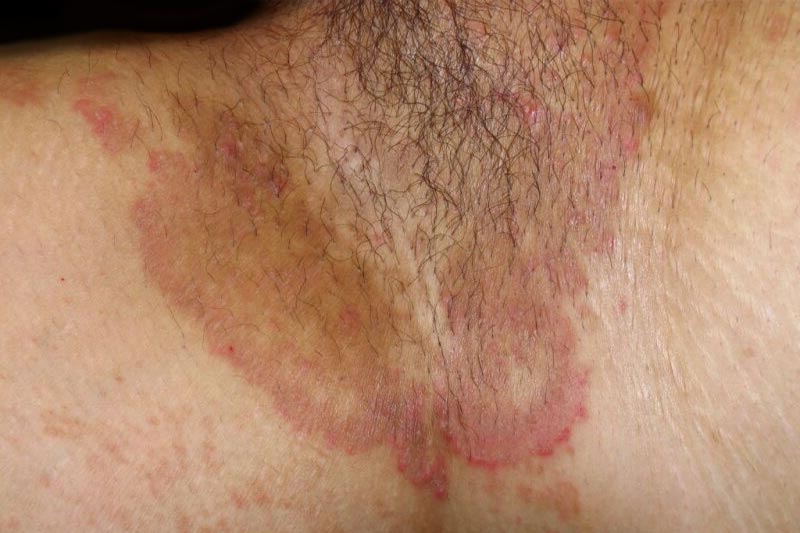 You are currently viewing Homeopathic Medicines for Fungal Infection