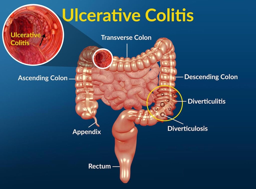 Homeopathy-treatment-for-ulcerative-collitis